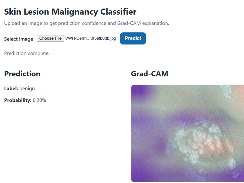 Skin Lesion Malignancy Classifier — ML Medical Imaging